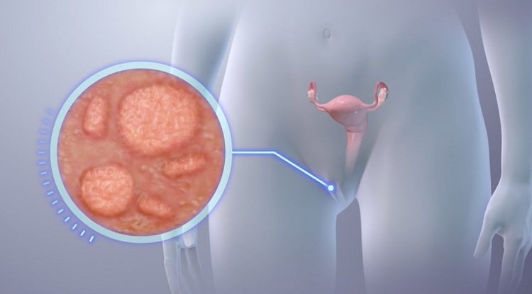 ¿Cómo identificar  si una verruga es Virus de Papiloma Humano (VPH)?